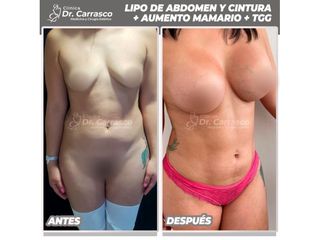 Lipoescultura - Dr. Freddy Carrasco