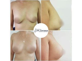 Aumento mamario - Dr. Freddy Carrasco