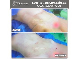 Liposucción HD - Dr. Freddy Carrasco