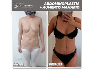 Abdominoplastia - Dr. Freddy Carrasco