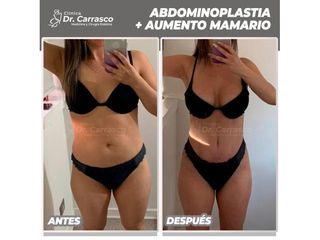 Abdominoplastia - Dr. Freddy Carrasco