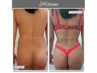 Liposucción - Dr. Freddy Carrasco