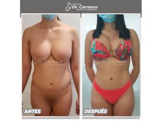 Liposucción - Dr. Freddy Carrasco