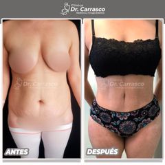 Abdominoplastia - Dr. Freddy Carrasco