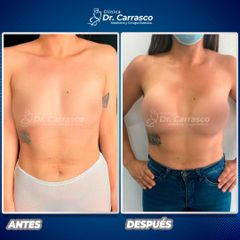 Aumento mamario - Dr. Freddy Carrasco