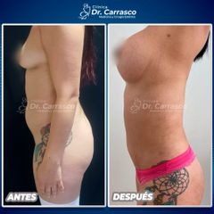 Aumento mamario - Dr. Freddy Carrasco