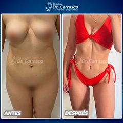 Liposucción - Dr. Freddy Carrasco