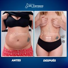 Abdominoplastia - Dr. Freddy Carrasco