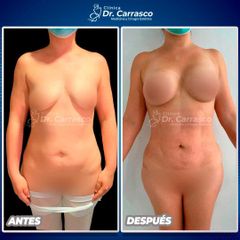 Liposucción - Dr. Freddy Carrasco