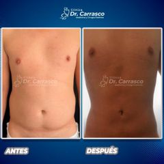 Liposucción - Dr. Freddy Carrasco