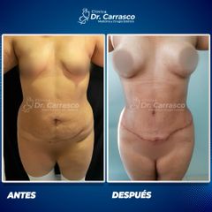 Abdominoplastia - Dr. Freddy Carrasco