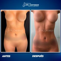 Abdominoplastia - Dr. Freddy Carrasco