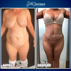 Abdominoplastia - Dr. Freddy Carrasco