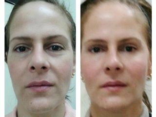 Rejuvenecimiento facial 3D
