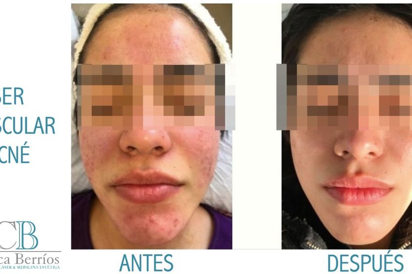 Tratamiento acné antes y después - 713853