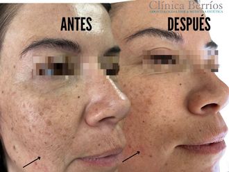 Rejuvenecimiento facial antes y después - 866514