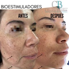 Bioestimuladores - Clinica Berrios