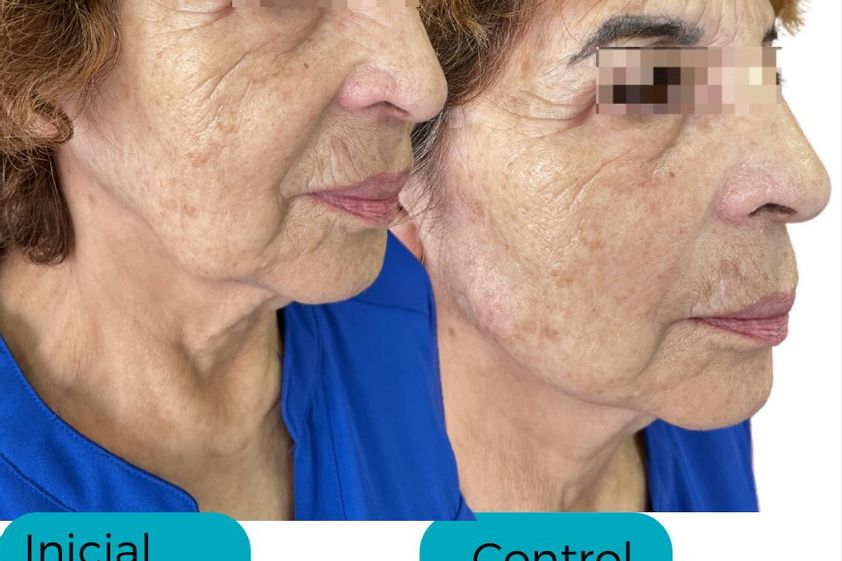 Hilos tensores antes y después - 866516