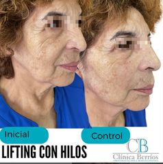 Hilos tensores - Clinica Berrios