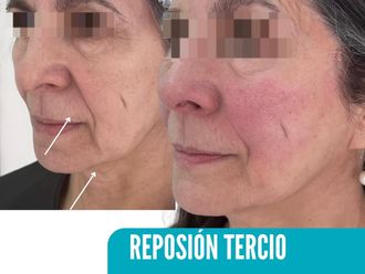 Rejuvenecimiento facial antes y después - 866517