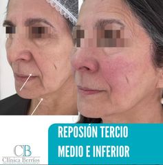 Rejuvenecimiento facial -  Clinica Berrios