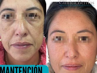 Rejuvenecimiento facial antes y después - 866518