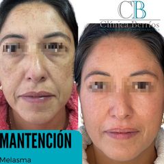 Rejuvenecimiento facial -  Clinica Berrios