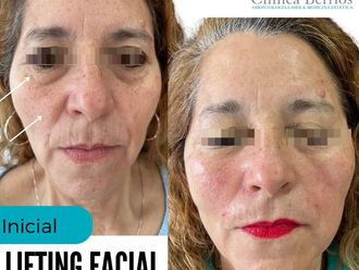 Rejuvenecimiento facial antes y después - 866519