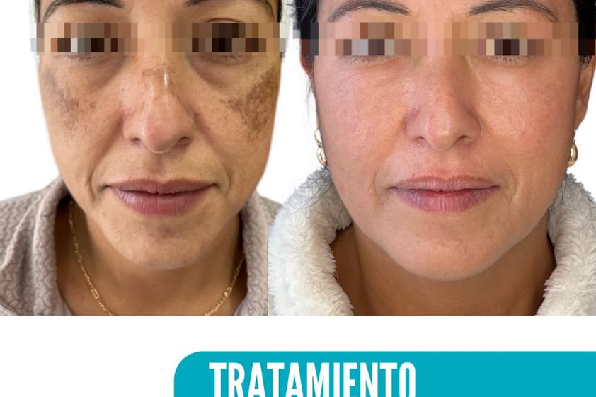 Manchas de la piel antes y después - 866525