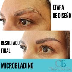 Microblanding - Clínica Berríos