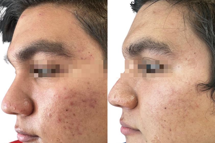 Tratamiento acné antes y después - 866529