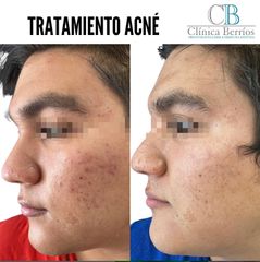 Tratamiento Acne - Clinica Berrios