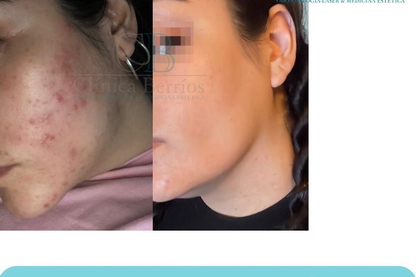 Tratamiento acné antes y después - 866530