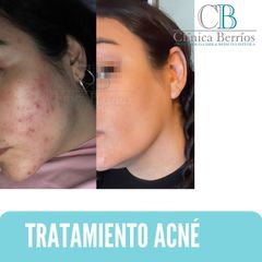 Tratamiento Acne - Clinica Berrios