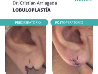 Otoplastia antes y después - 869674