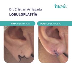 Lobuloplastia - Made Esthetic