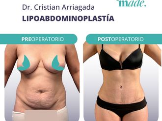 Abdominoplastía antes y después - 869675