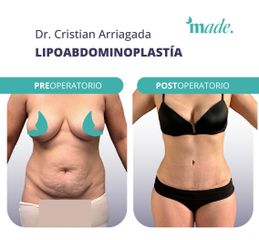 Lipoabdominoplastia - Made Esthetic