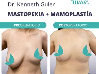 Mastopexia antes y después - 869676