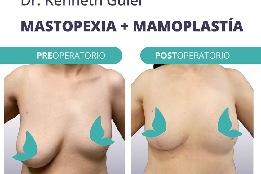 Mastopexia antes y después - 869676