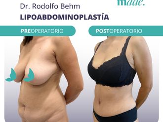 Abdominoplastía antes y después - 869677