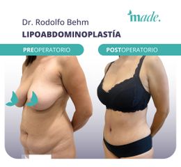 Lipoabdominoplastia - Made Esthetic