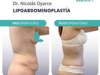 Abdominoplastía antes y después - 869678