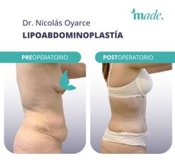 Lipoabdominoplastia - Made Esthetic