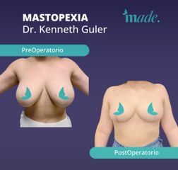 Mastopexia - Made Esthetic