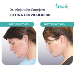 Lifting cervicofacial - Made Esthetic