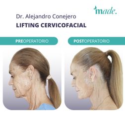 Lifting cervicofacial - Made Esthetic