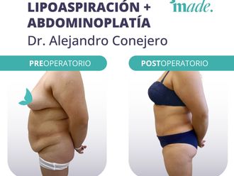 Abdominoplastía antes y después - 869682