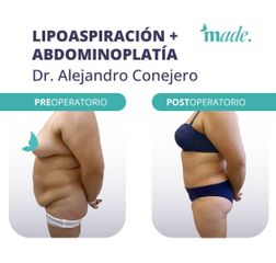 Lipoaspiración + Abdominoplastia - Made Esthetic