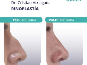 Rinoplastía antes y después - 869683